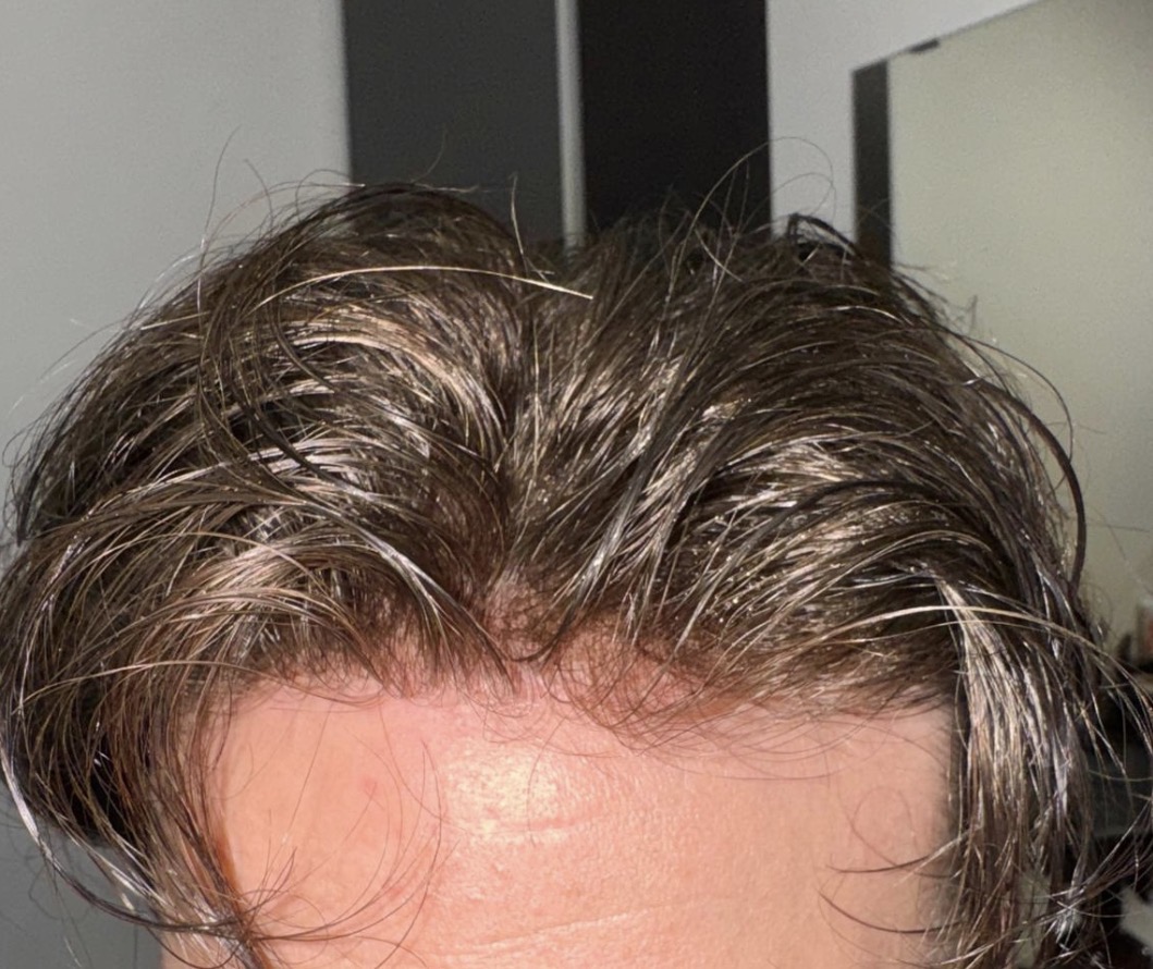 Dettaglio impianto capillare Rinascimento Capelli